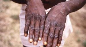 5 Types Of Business Blogs and how they work. 22 Nigeria Center for Disease Control confirms 49 cases of Monkeypox.